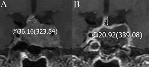 pituitary stalk deviated to left.